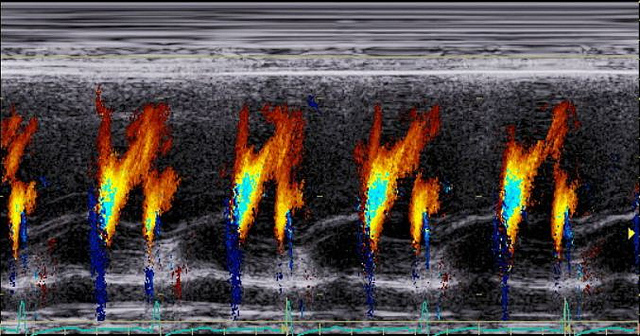 echocardiagram heart beat