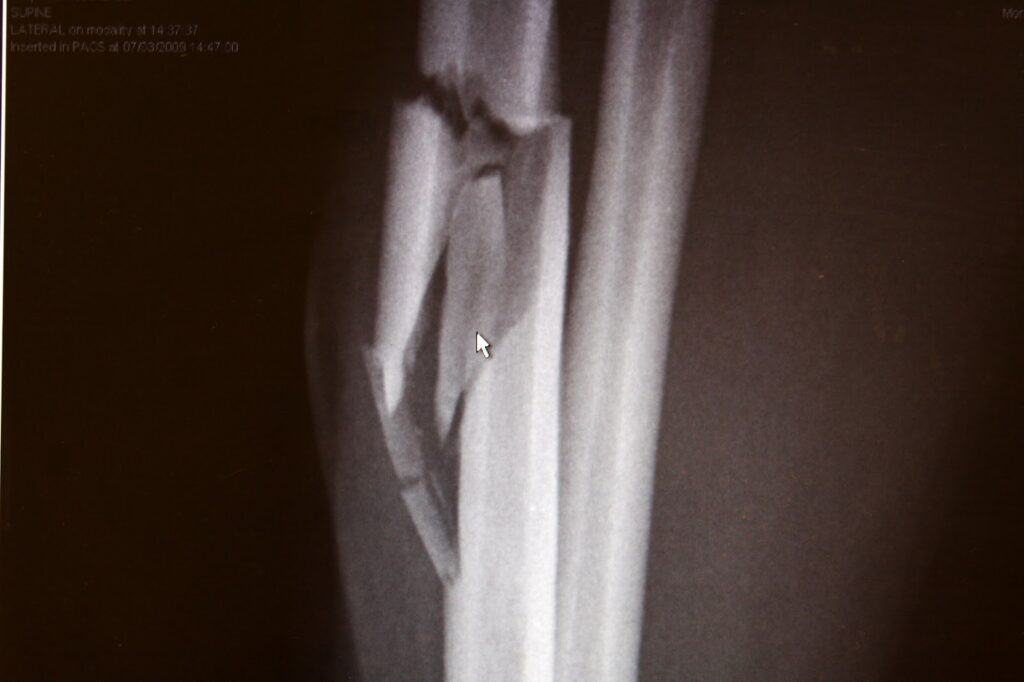 xray of broken bone