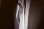 xray of broken bone